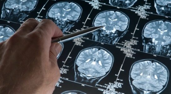 prevention trial - brain scan images