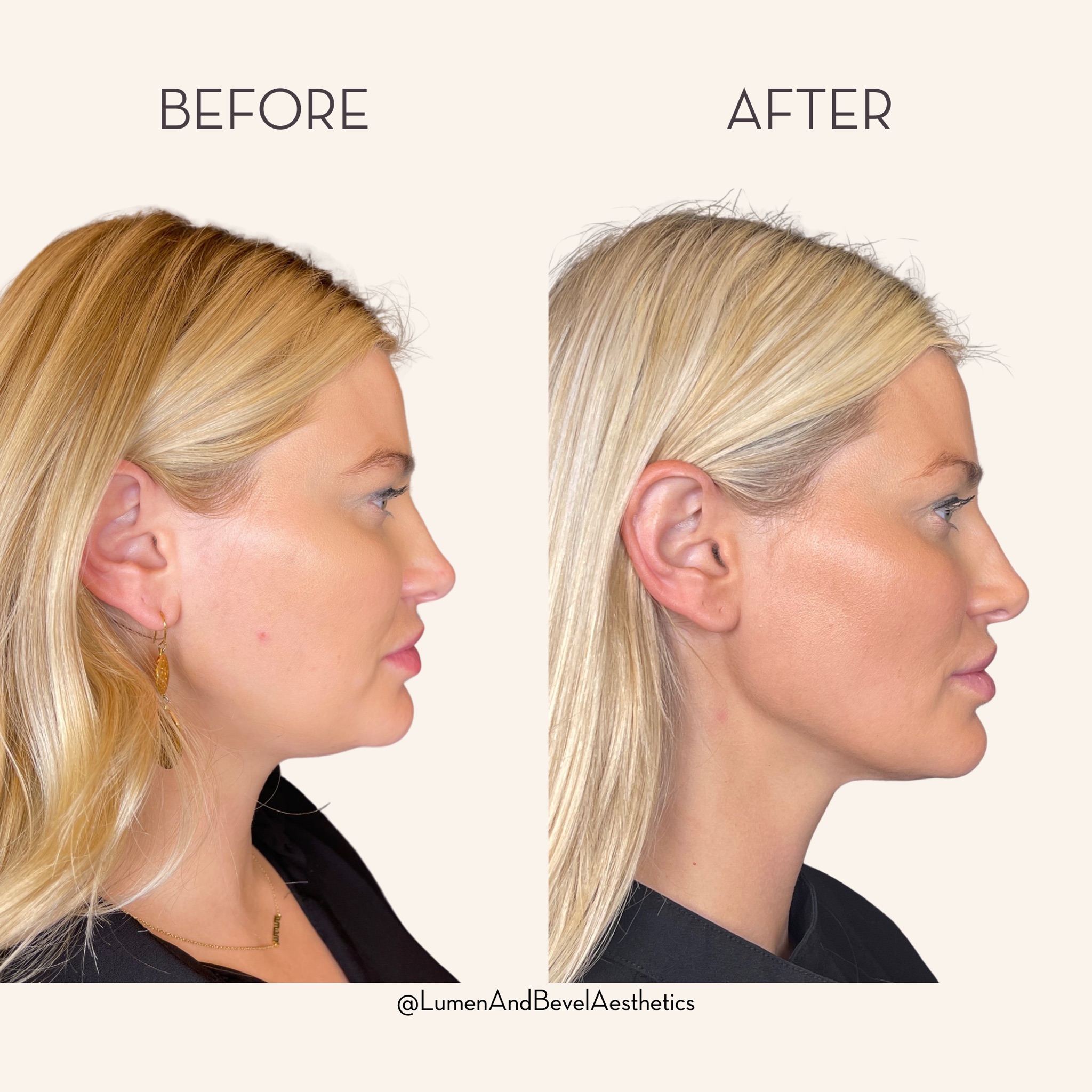 The Hourlift: Non-surgical facelift procedures can be done over