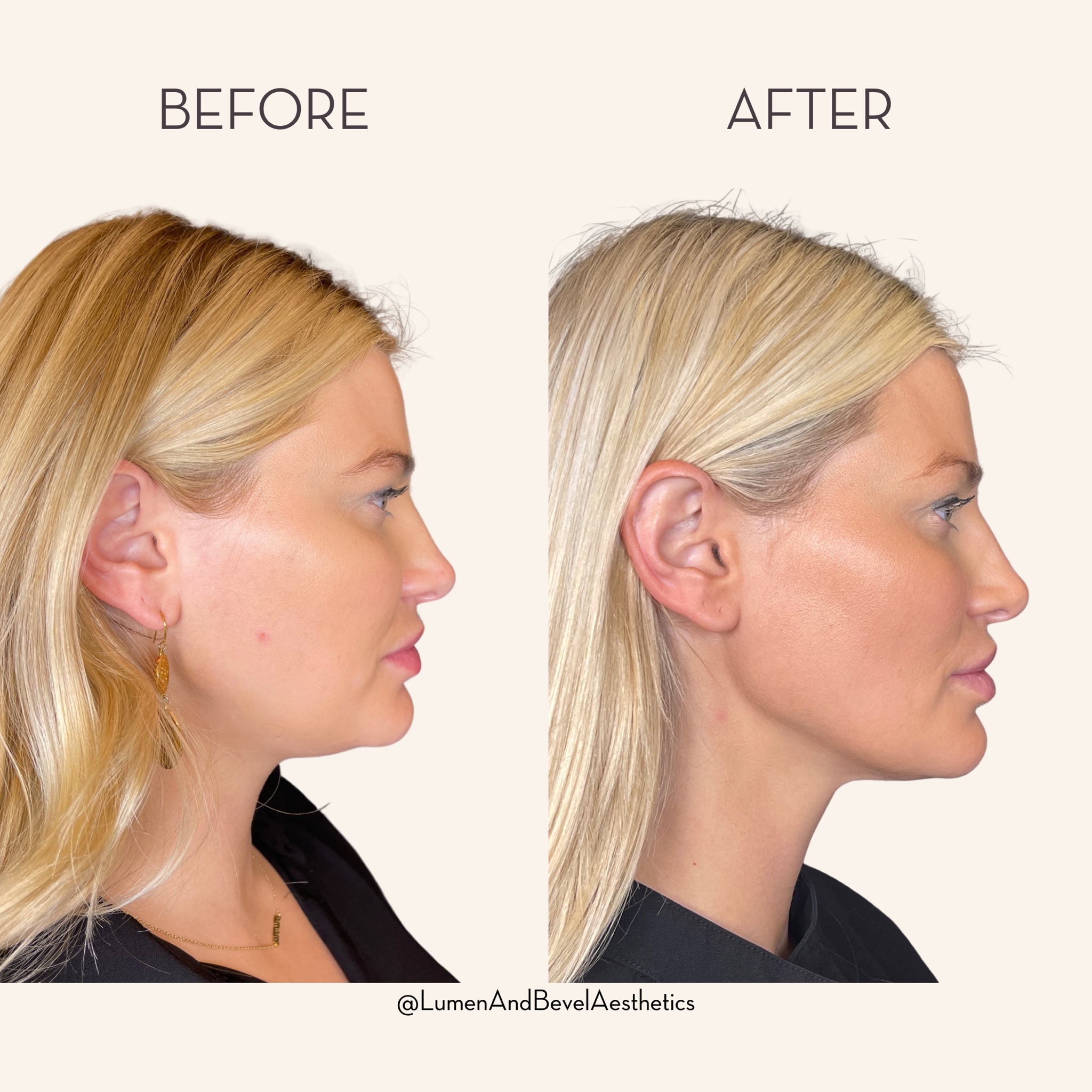 A New Approach To The Non-Surgical Facelift