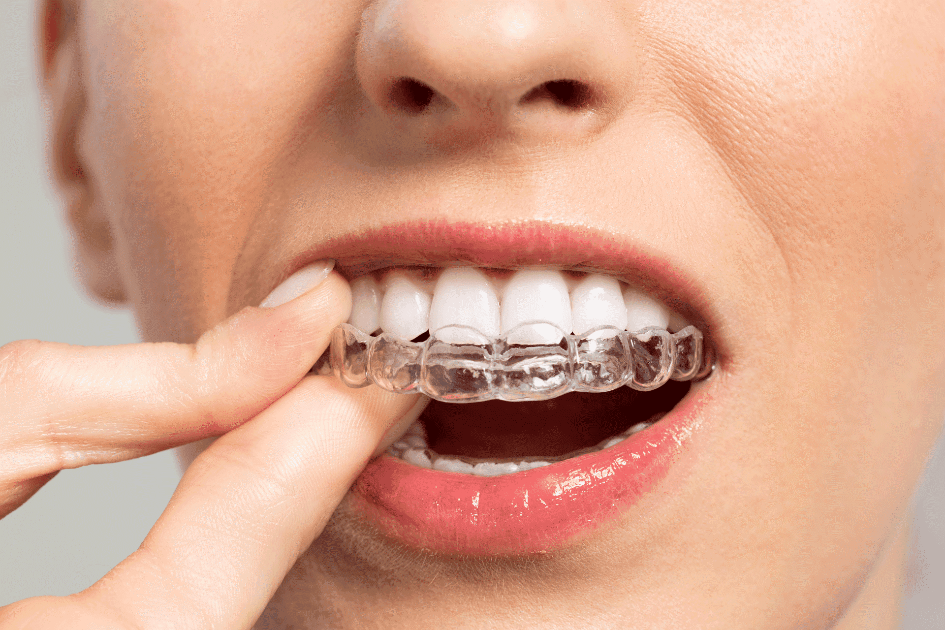 What are Invisalign Attachments? Why Are They Needed? - Dental Health  Society