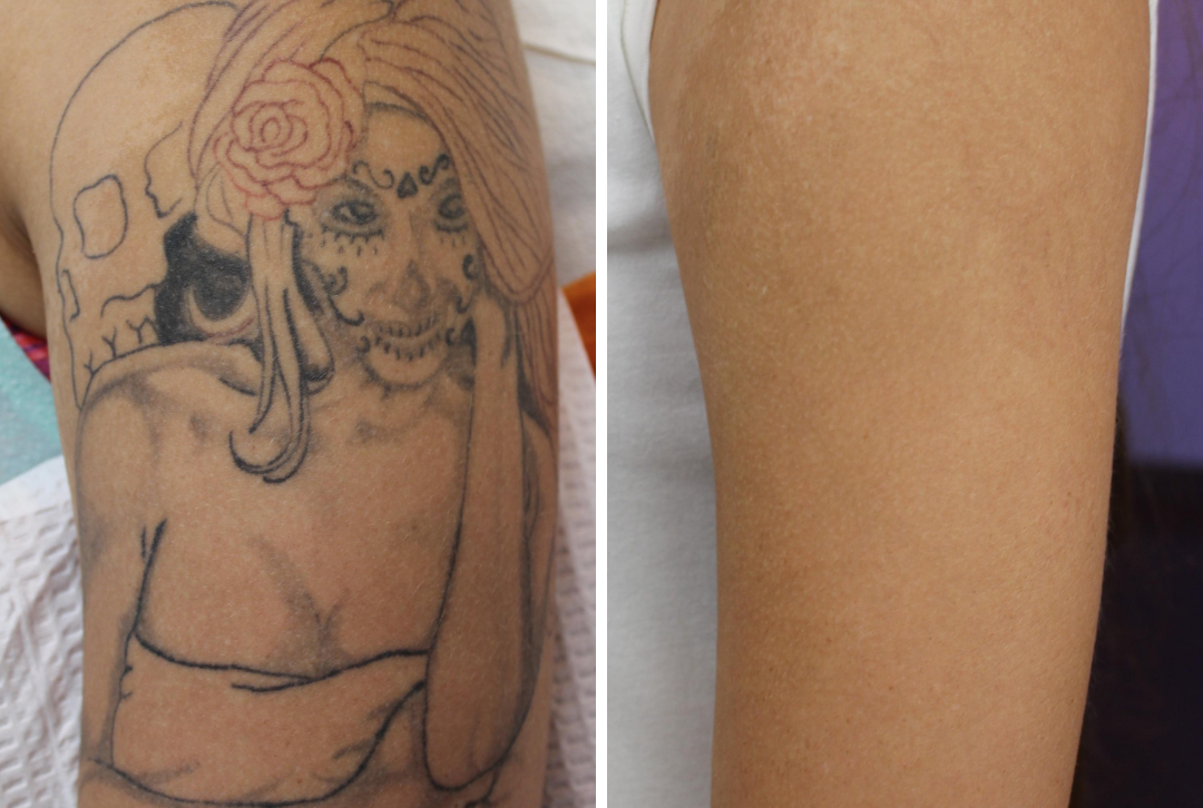 Delete Tattoo Removal patents innovative new treatment – AZ Big Media