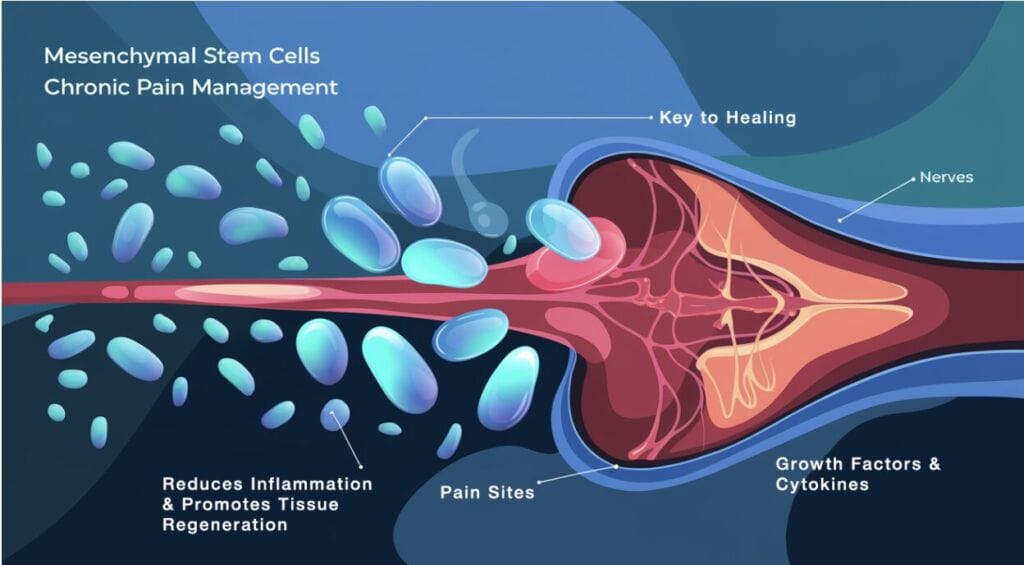 Mesenchymal stem cell therapy: A game changer for chronic pain ...
