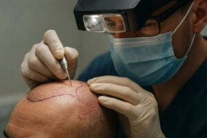 Hazem Altal: Why many men delay hair transplants and why regret is common