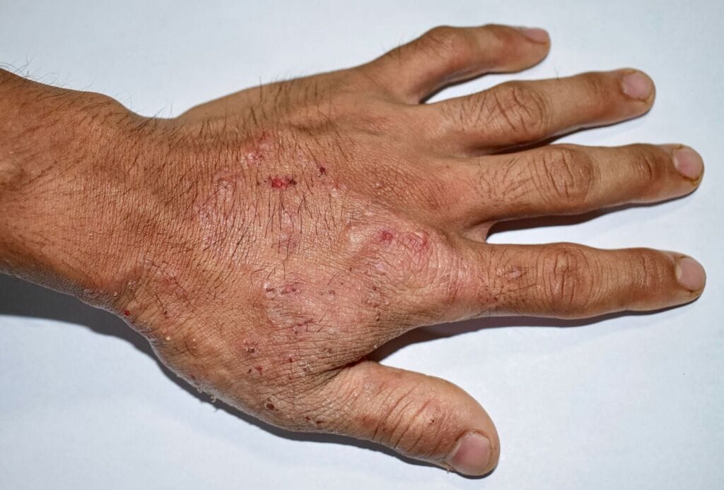 Scabies treatment options and how to use them