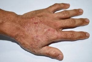 Scabies treatment options and how to use them